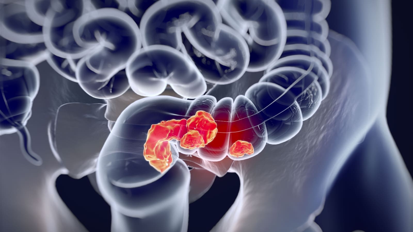 Colon cancer. 