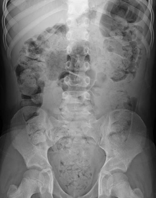 Constipation(lots) 