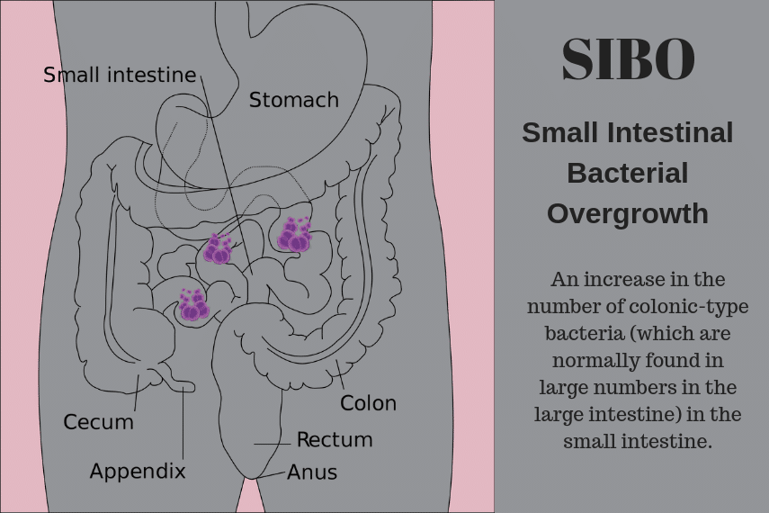 SIBO: Get the facts - FODMAP Everyday 